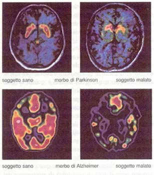 Cervello malato